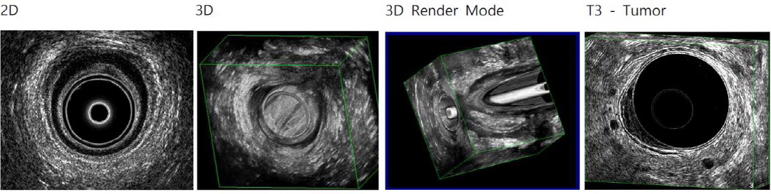 항문초음파2D-3D-3DRenderMode-T3Tumor